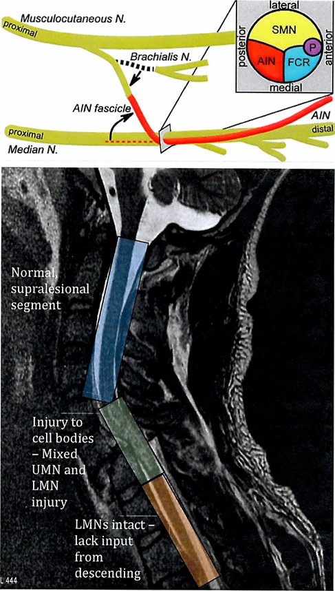 Nerve transfer for spinal cord injury
